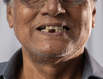 Closeup of a man’s smile with missing teeth