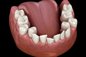 Illustration of crowded teeth